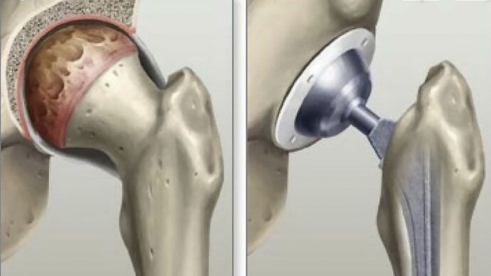 Arthroplastie de la hanche réalisée dans les derniers stades de la coxarthrose