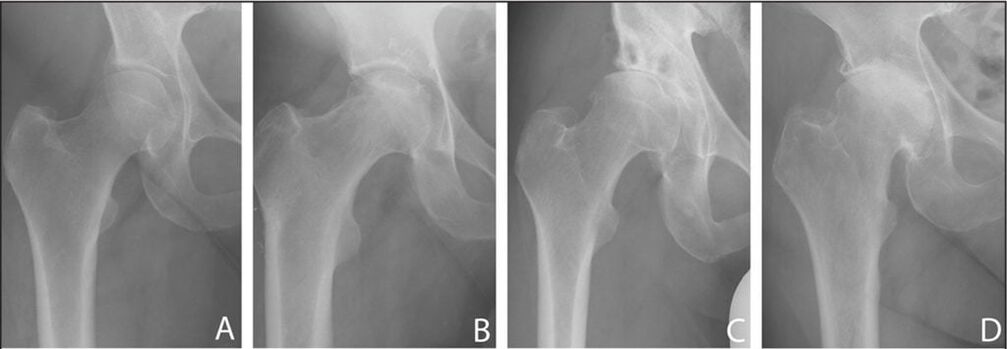 Stades de développement de l'arthrose de l'articulation de la hanche sur une radiographie