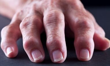 Quelle est la différence entre l'arthrite de l'arthrose