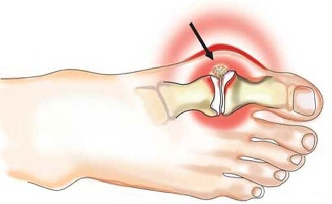 Inflammation de l'articulation entre le gros orteil et le pied due à l'arthrite