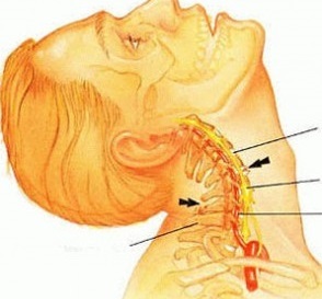 causes de l'ostéochondrose cervicale