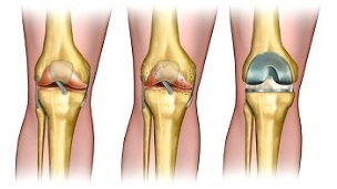 endoprothèses pour l'arthrose de l'articulation du genou